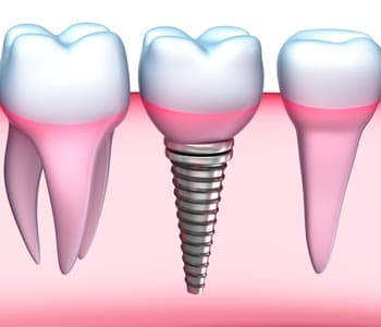 Calgary dental practice offers restorative crown procedure