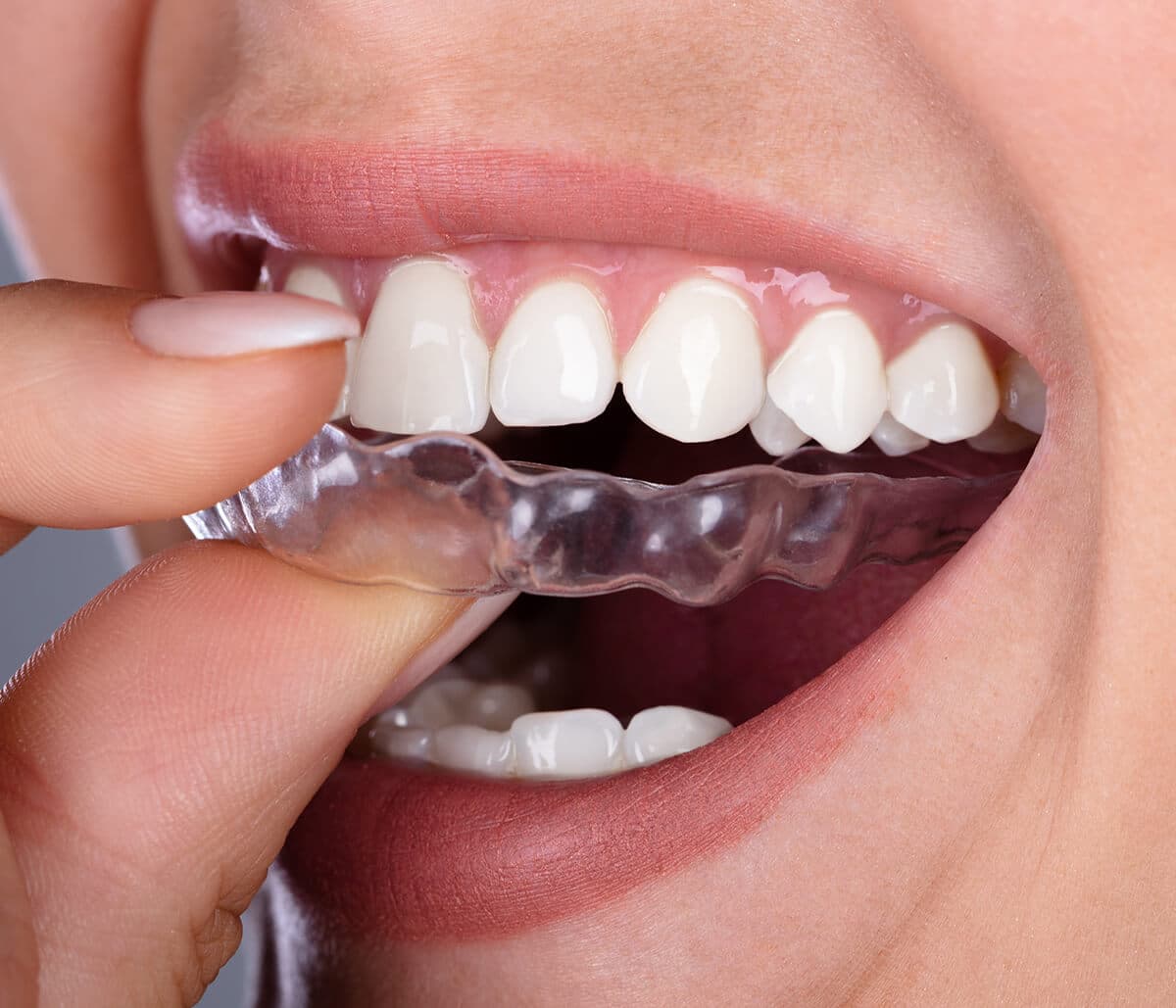 Calgary dentist points to the benefits of Invisalign clear aligners
