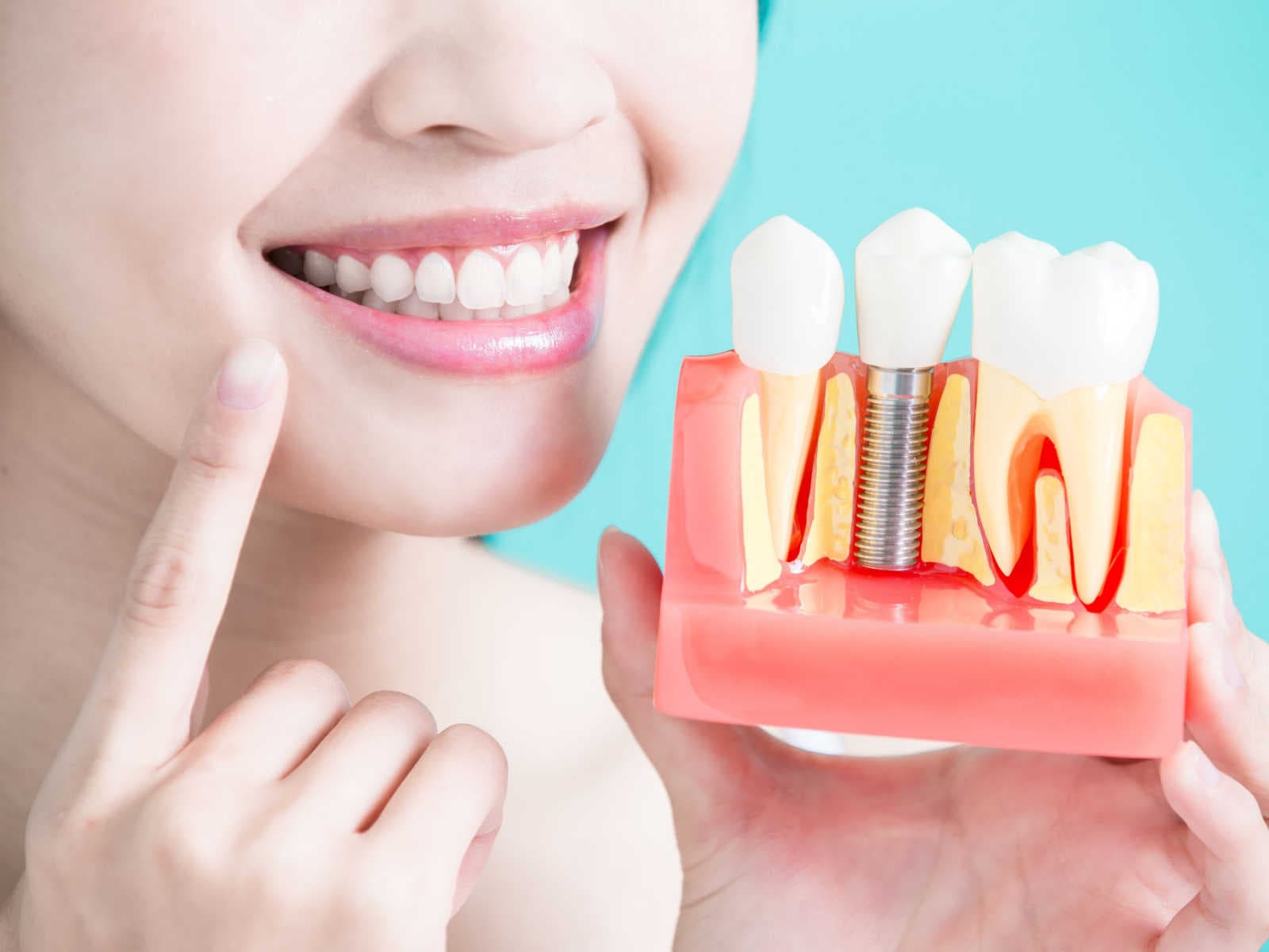 How Long Do Dental Implants Last?