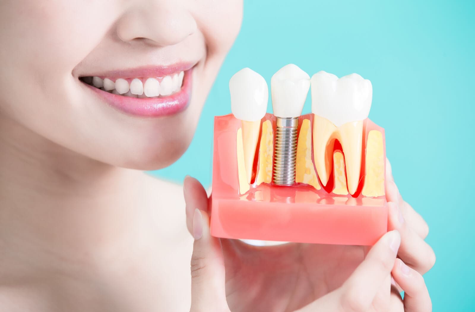 Types of Dental Implants: Ceramic, Zirconia, and Metal