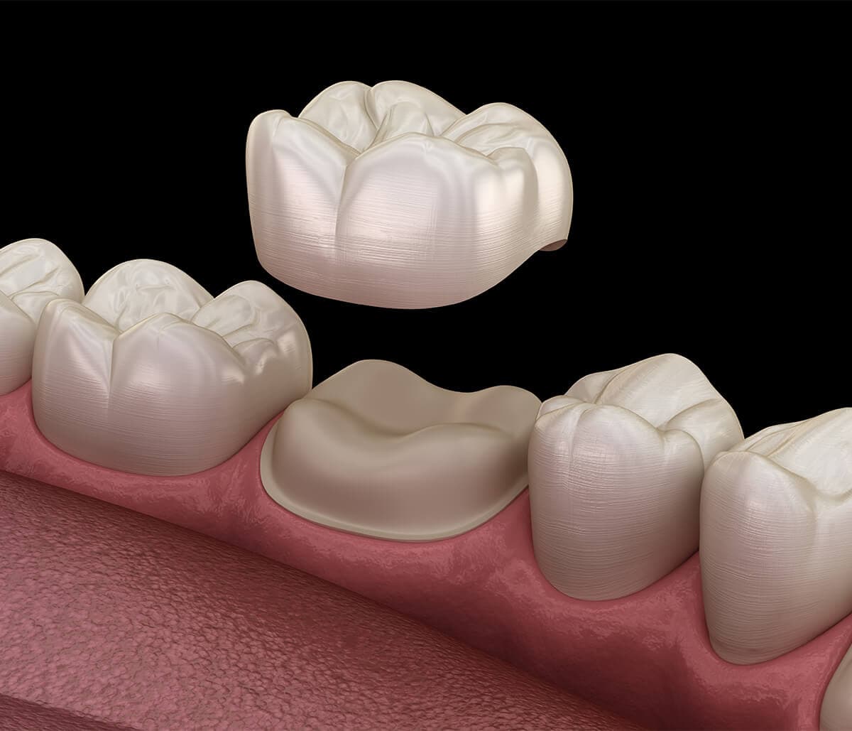 How to obtain dental restorations in one visit