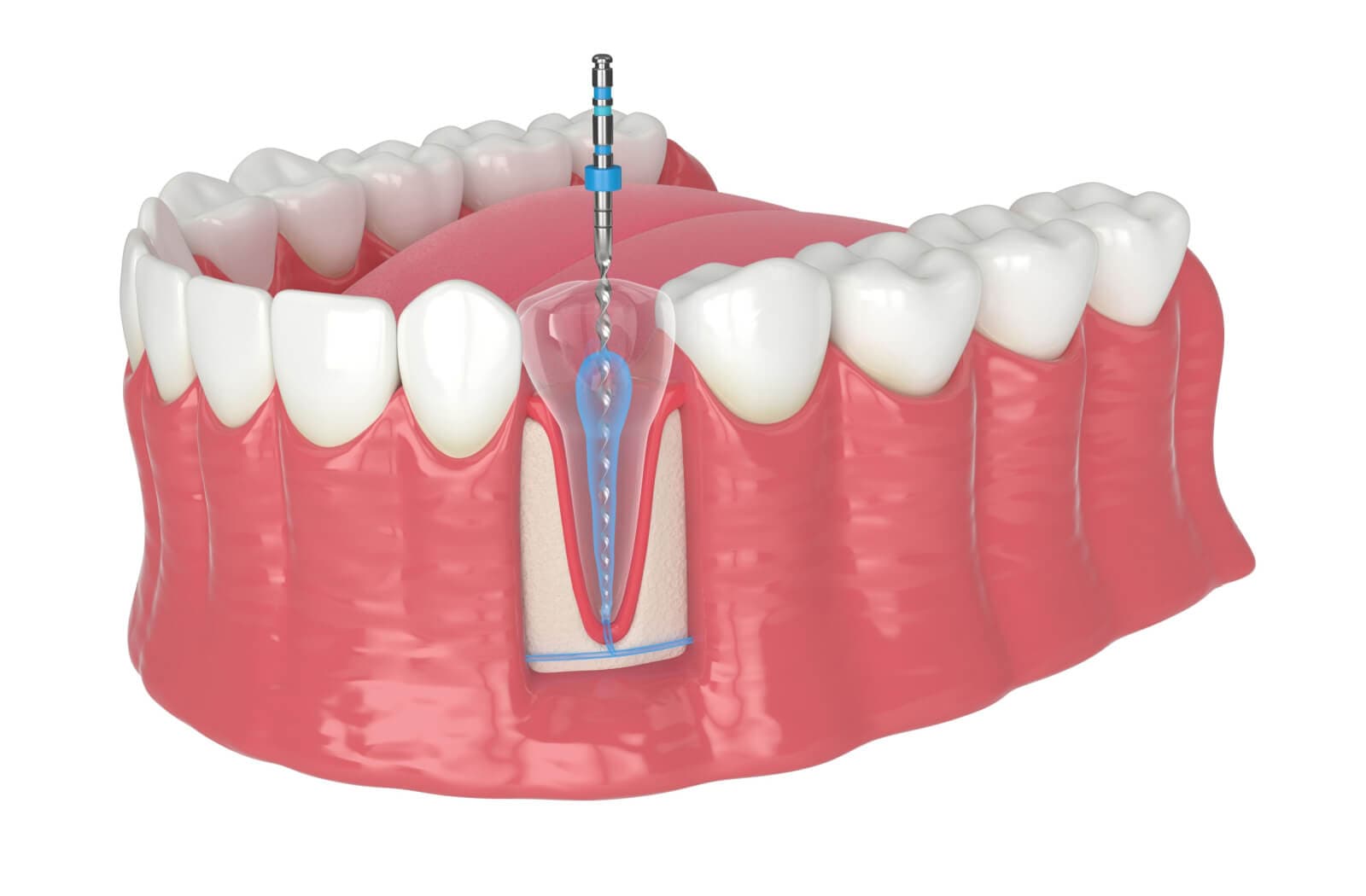 Are Root Canals Bad for You?