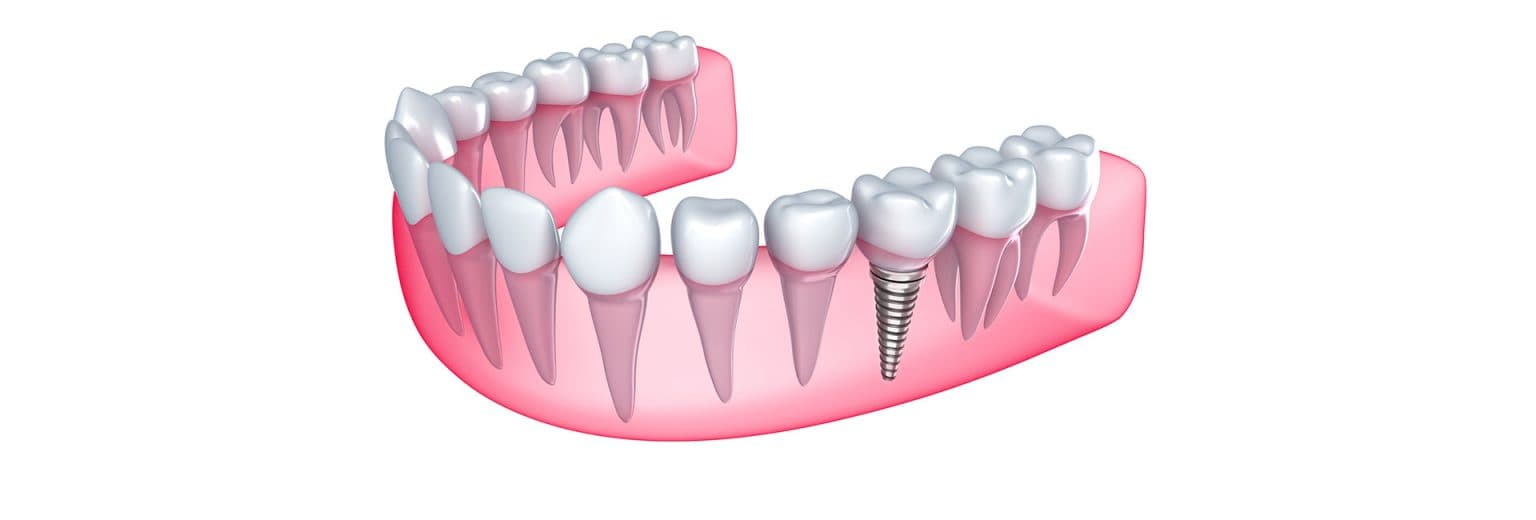 Single Implants