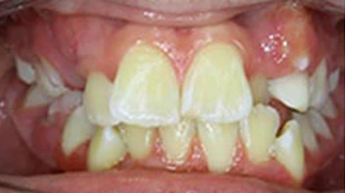 Biobloc Orthotropics — before