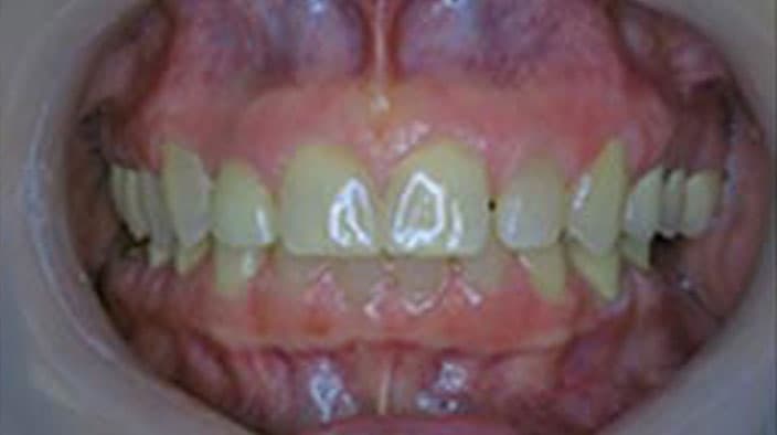 Dental Implants — after