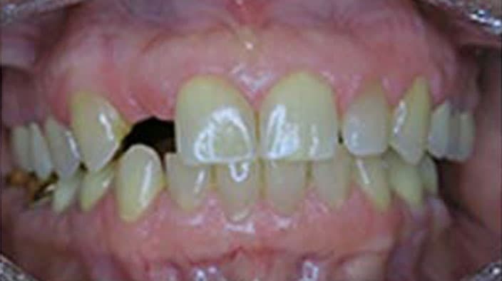 Dental Implants — before