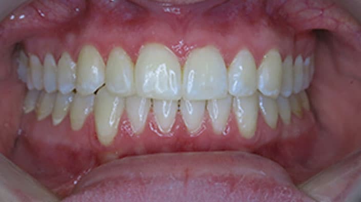 Invisalign — after