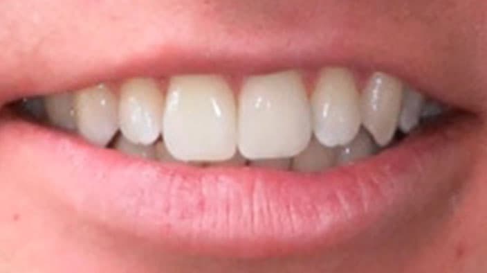 Invisalign — after
