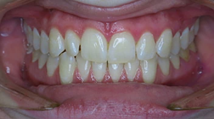Invisalign — before