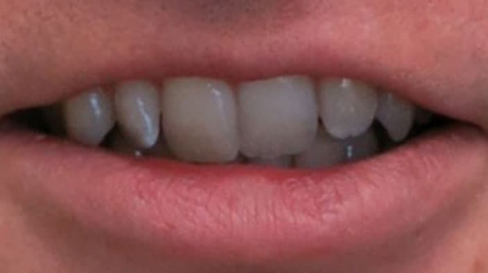 Invisalign — before