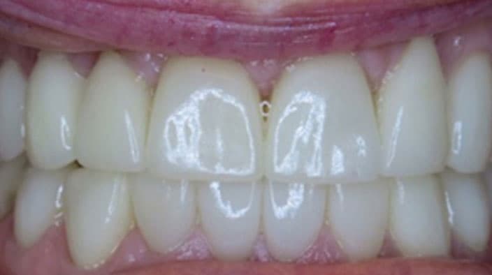 Veneers — after
