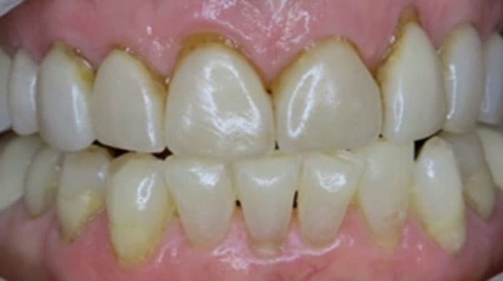 Veneers — before