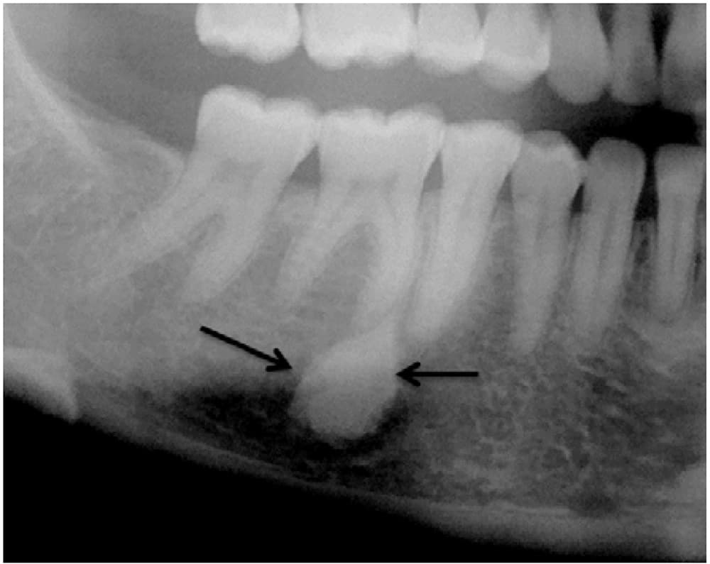 Jaw Bone Lesion Removal